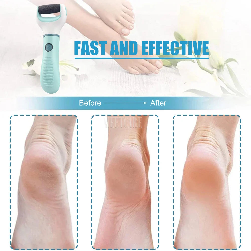 SmoothStep Pro™ – Electric Callus Remover