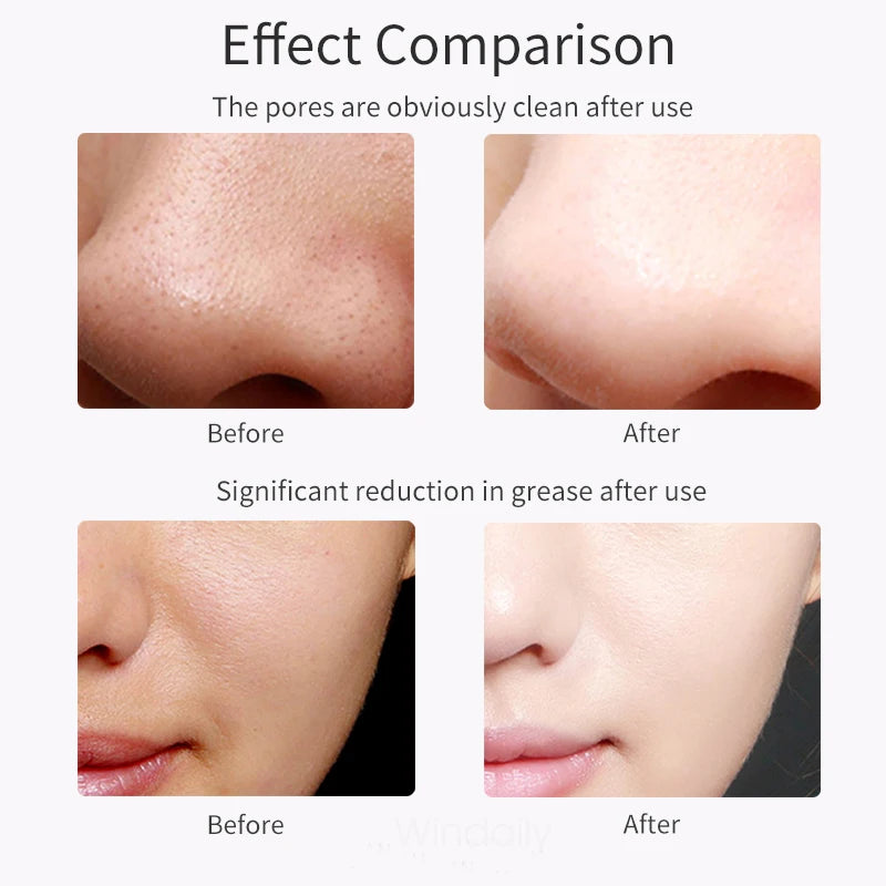 GlowSonic Pro™ – Ultrasonic Skin Scrubber